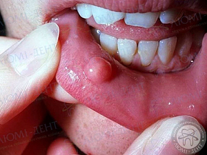 Шишка‌ ‌во‌ ‌рту‌ ‌-‌ ‌причины,‌ ‌возможные‌ ‌ заболевания‌ ‌и‌ ‌способы‌ ‌лечения‌